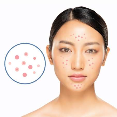 light-skinned, female presenting person showing Problematic (Acne-prone) Skin
