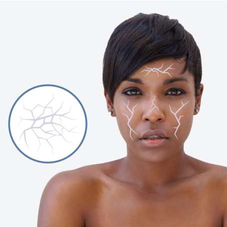 dark skinned, female presenting person with dry skin zones